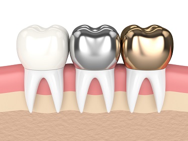 types of teeth cap 